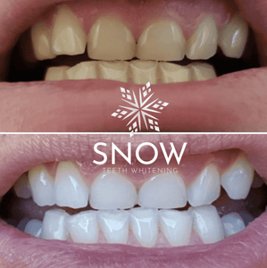 SNOW Teeth Whitening + Lip Balm Bundle